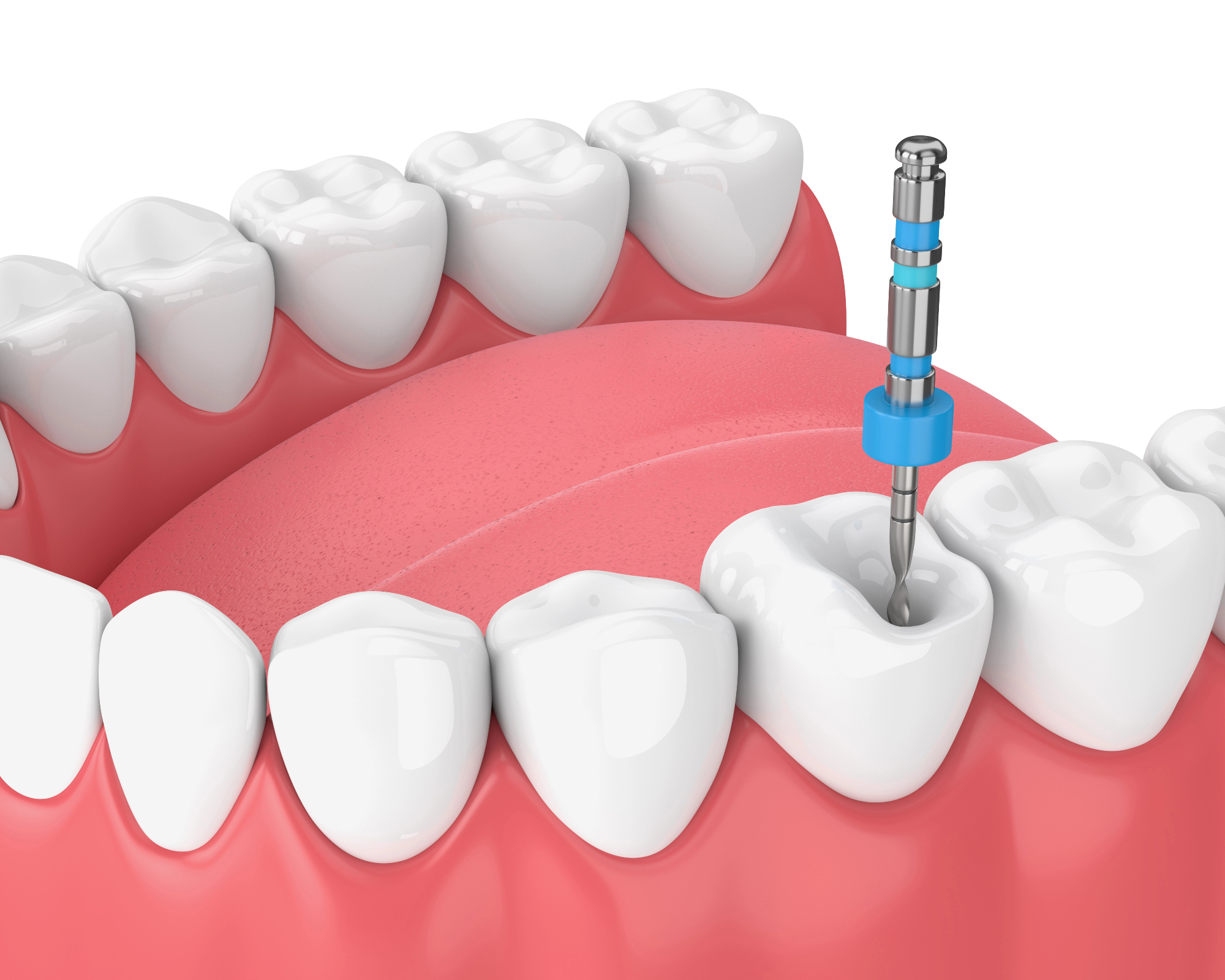 Endodontija je pomembna veja zobozdravstva
